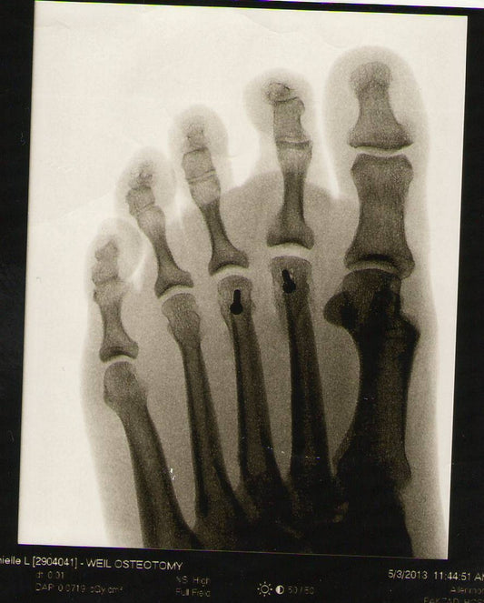 The Causes and Treatment of Metatarsal Pain